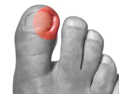 Có nhiều phương pháp điều trị bị chín mé ở ngón chân cái.