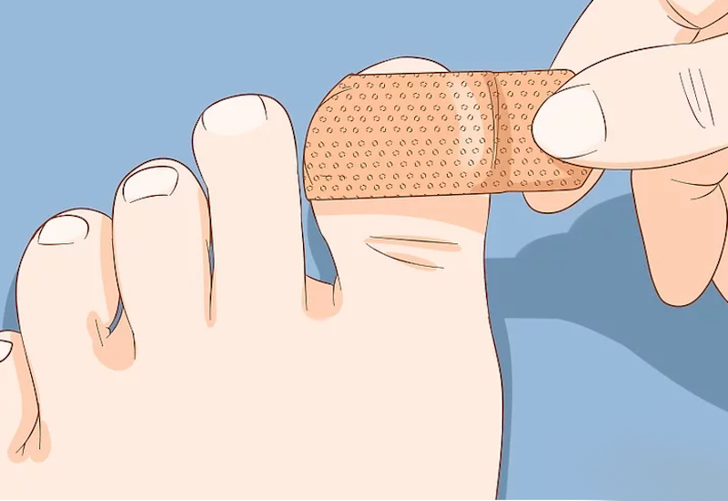 Móng chân bị lõm là hiện tượng bệnh lý gì?