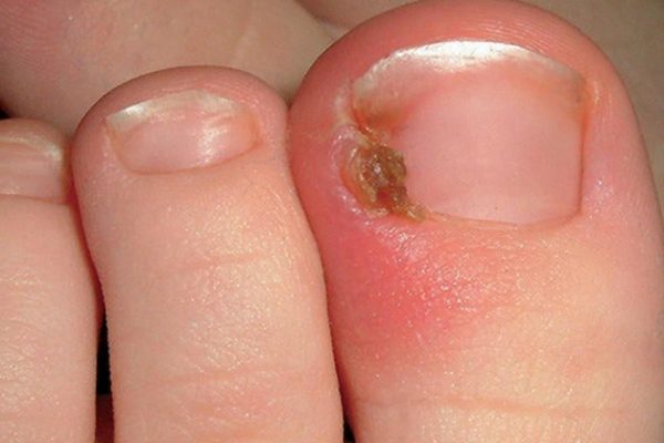 Viêm móng và quanh móng là các bệnh về móng chân thường gặp.