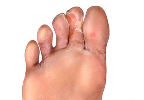 Có nhiều nguyên nhân gây ra bệnh viêm kẽ móng chân cái.