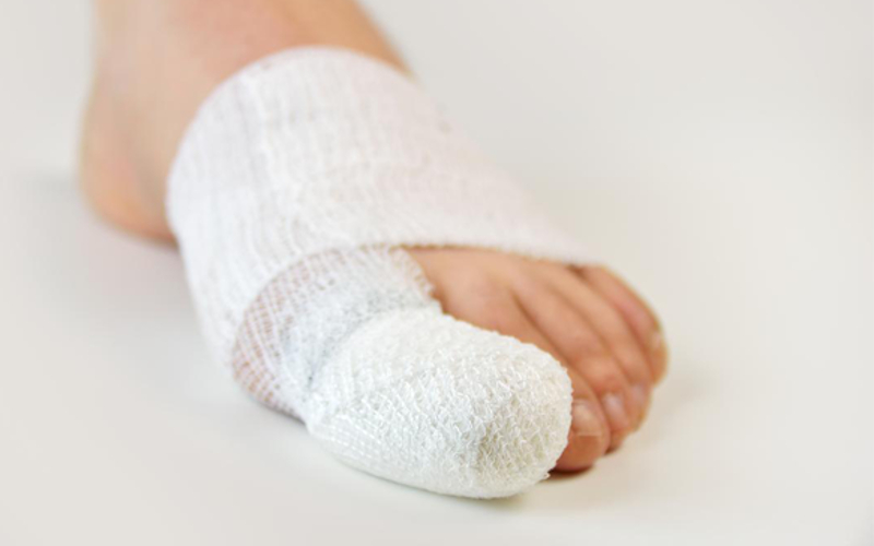 Băng ngón chân để bảo vệ khi bị mất móng chân