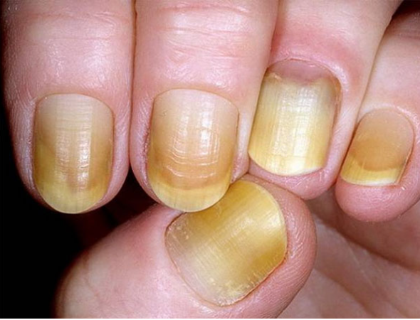 Biểu hiện của hội chứng móng tay vàng 