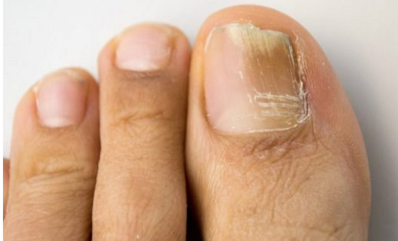 Bị thối móng chân là hiện tượng móng chân cái bị nhiễm một loại nấm tấn công và phá hủy móng khiến móng bị biến dạng