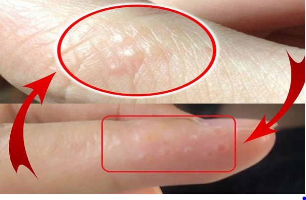 Bệnh tổ đỉa có mụn nước nhỏ gây ngứa ngón tay