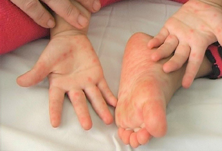 Dấu hiệu của viêm kẽ ngón chân: phát ban đỏ