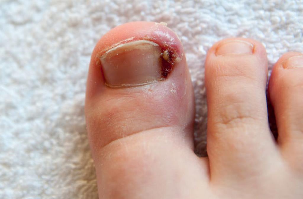 Móng chân đâm vào thịt là tình trạng phổ biến khi góc hoặc cạnh móng chân mọc đâm vào phần thịt