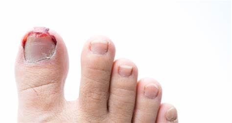 Kiểm tả tình trạng tổn thương của ngón chân